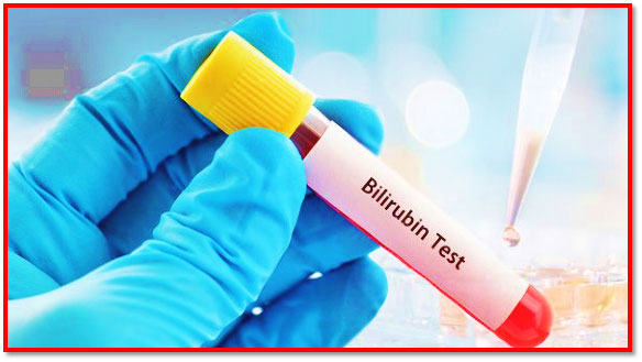 تفسیر آزمایش بیلی روبین | BILIRUBIN | Bili(T & D )