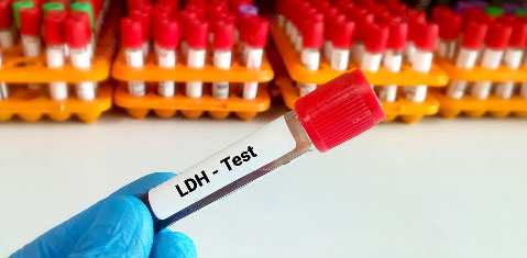 LDH | لاکتیک دهیدروژناز (LDH، لاکتات دهیدروژناز) | آزمایش LDH