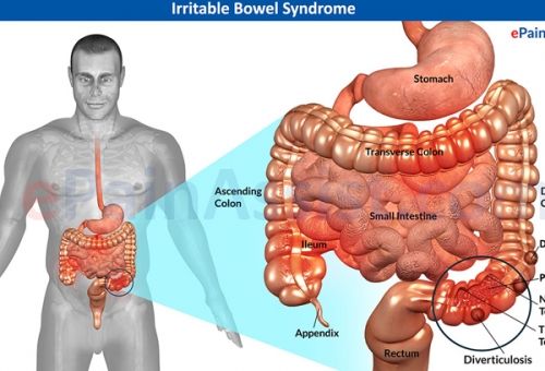 سندرم روده تحریک‌پذیر Irritable Bowel Syndrome